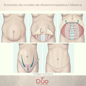 tudo sobre abdominoplastia 2