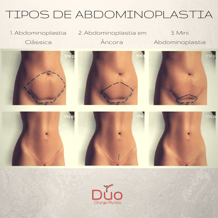tudo sobre abdominoplastia